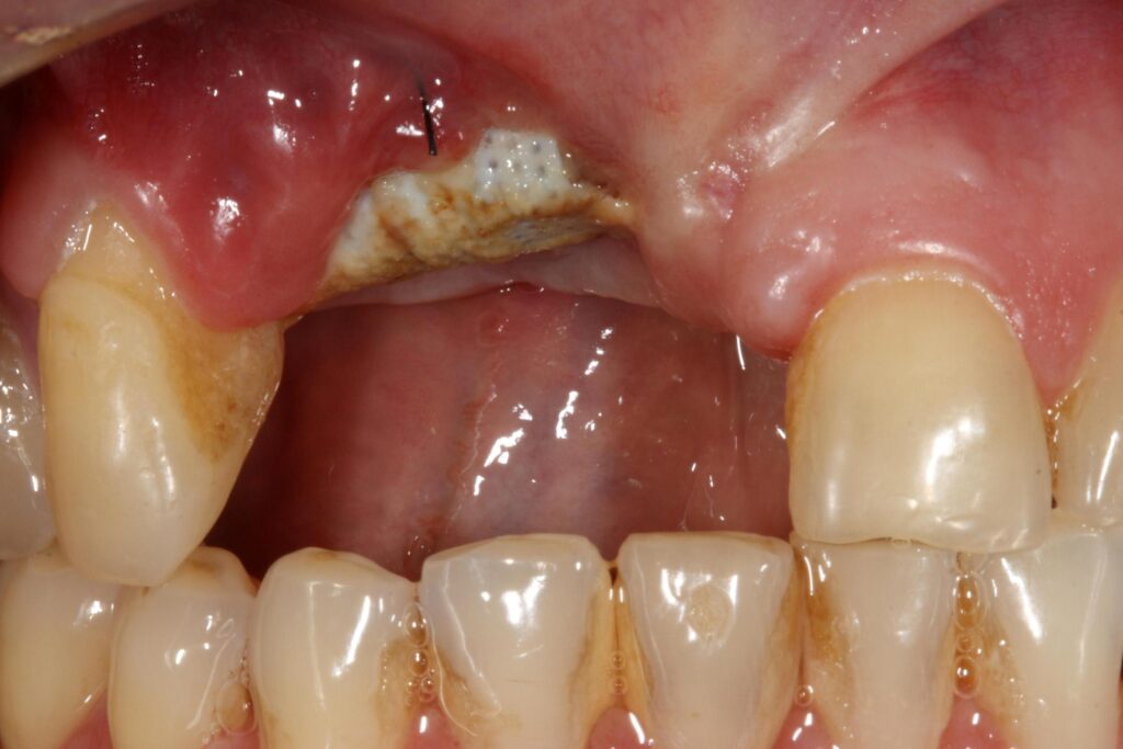 Signs of Failed Dental Bone Graft