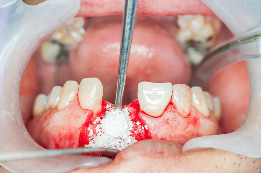 How Do I Know if My Dental Bone Graft is Healing