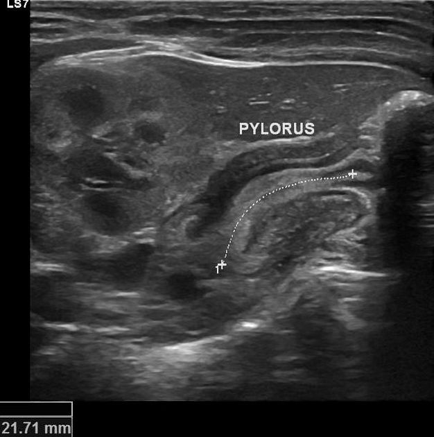 How Does An Ultrasound Detect Pyloric Stenosis