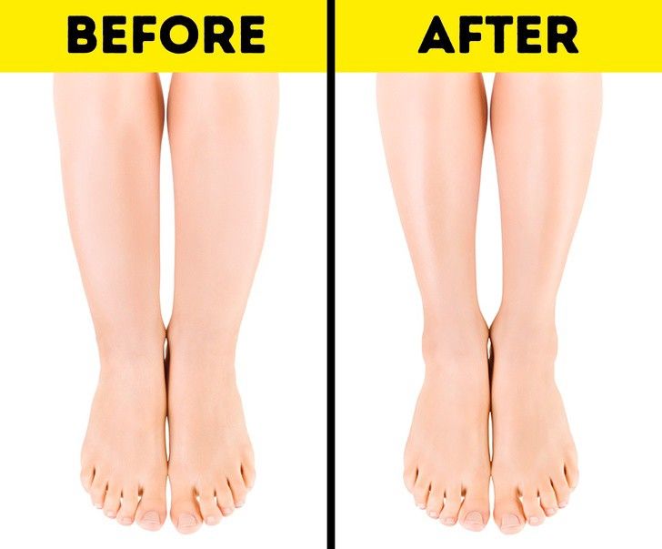 How I Got Rid of My Cankles