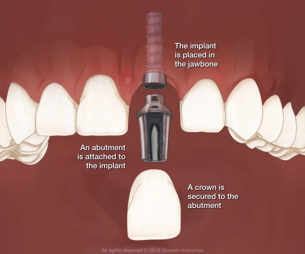 How Long After a Tooth is Pulled Can You Get an implant