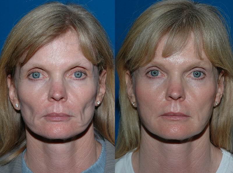 How Long Does Facial Fat Grafting Last