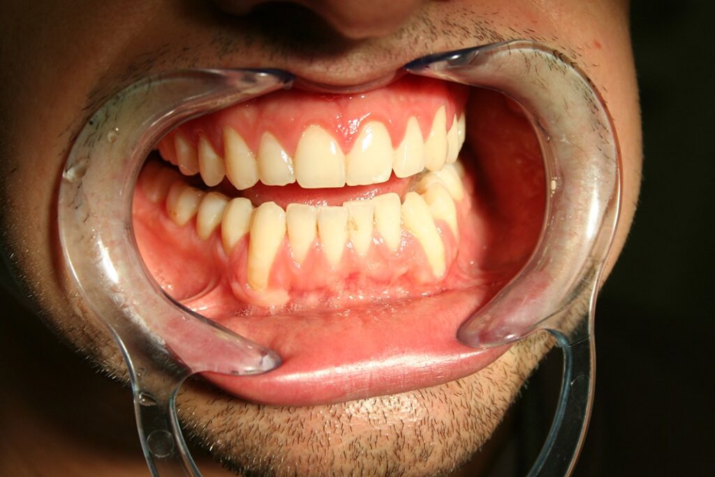 How Long Does Pinhole Gum Surgery Take