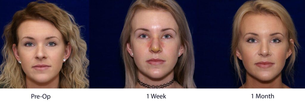 How Long Does it Take for Rhinoplasty Swelling to Go Down