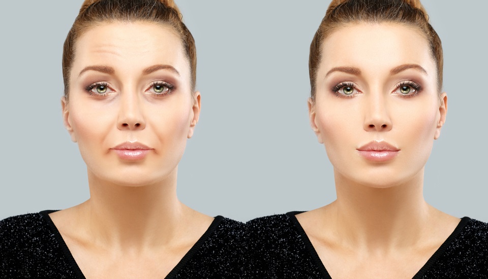 How Long do Nasolabial Fold Fillers Last