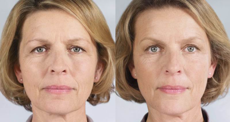 How Long do Sculptra injections Last