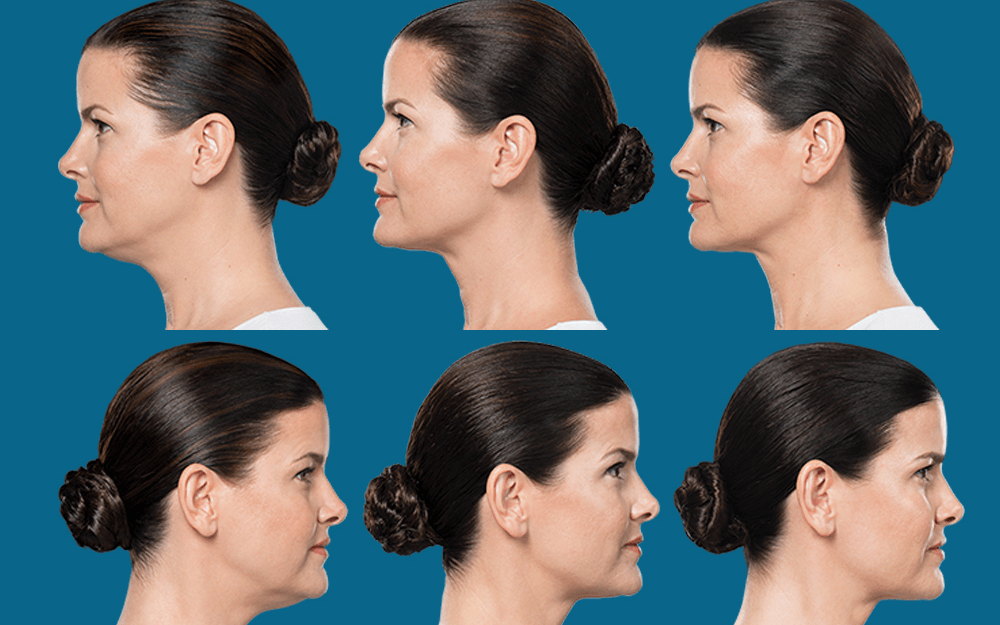 How Long do You Stay Swollen After Kybella