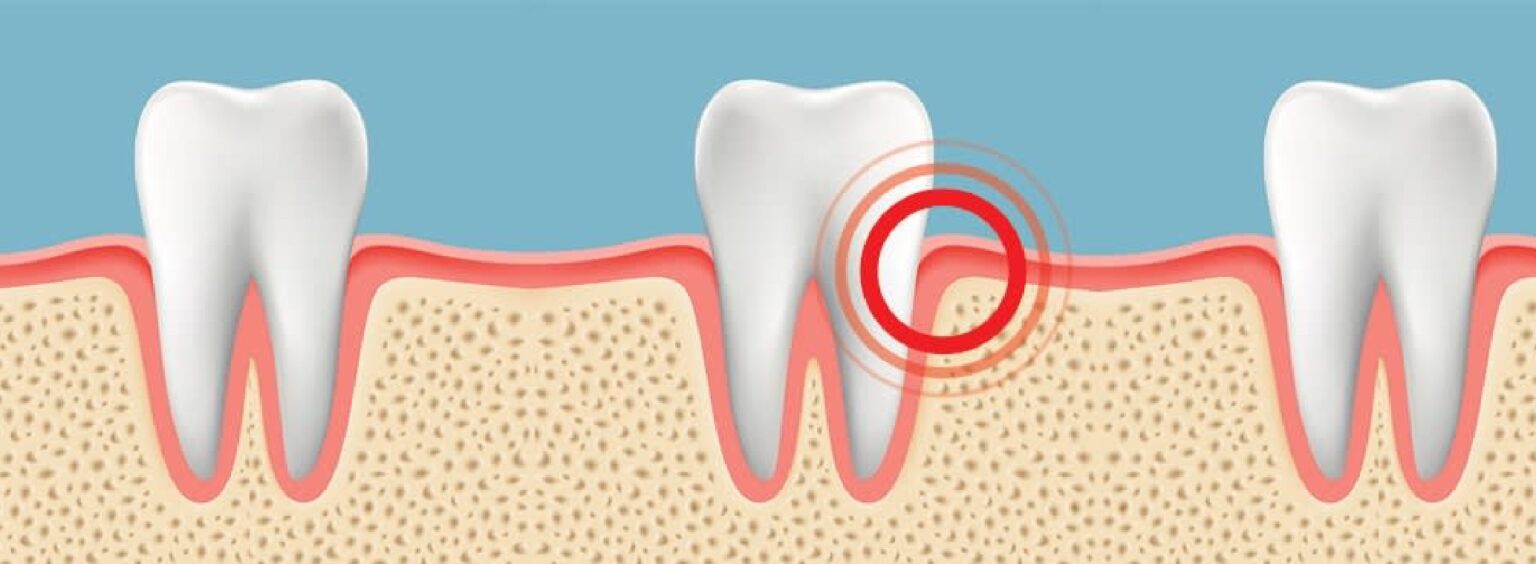 Gums Hurt After Flossing