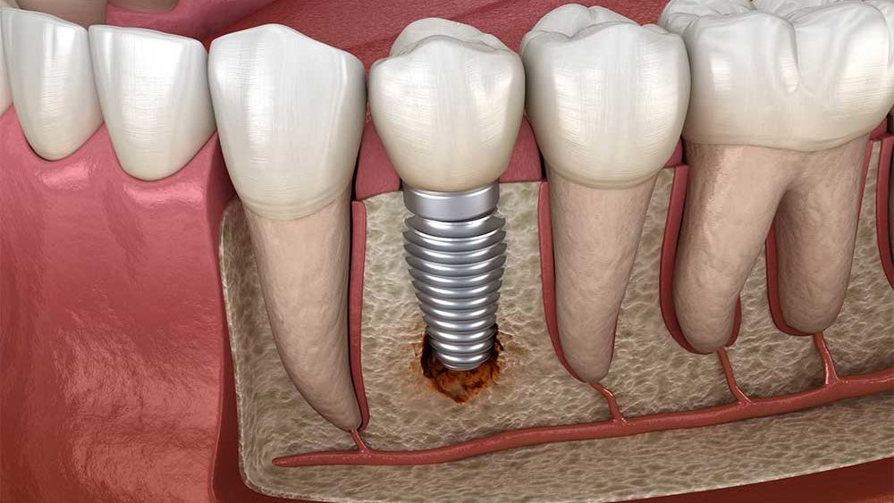 How Much Does it Cost for Bone Grafting