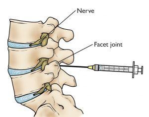 How Painful is a Lumbar Epidural Steroid injection Cost