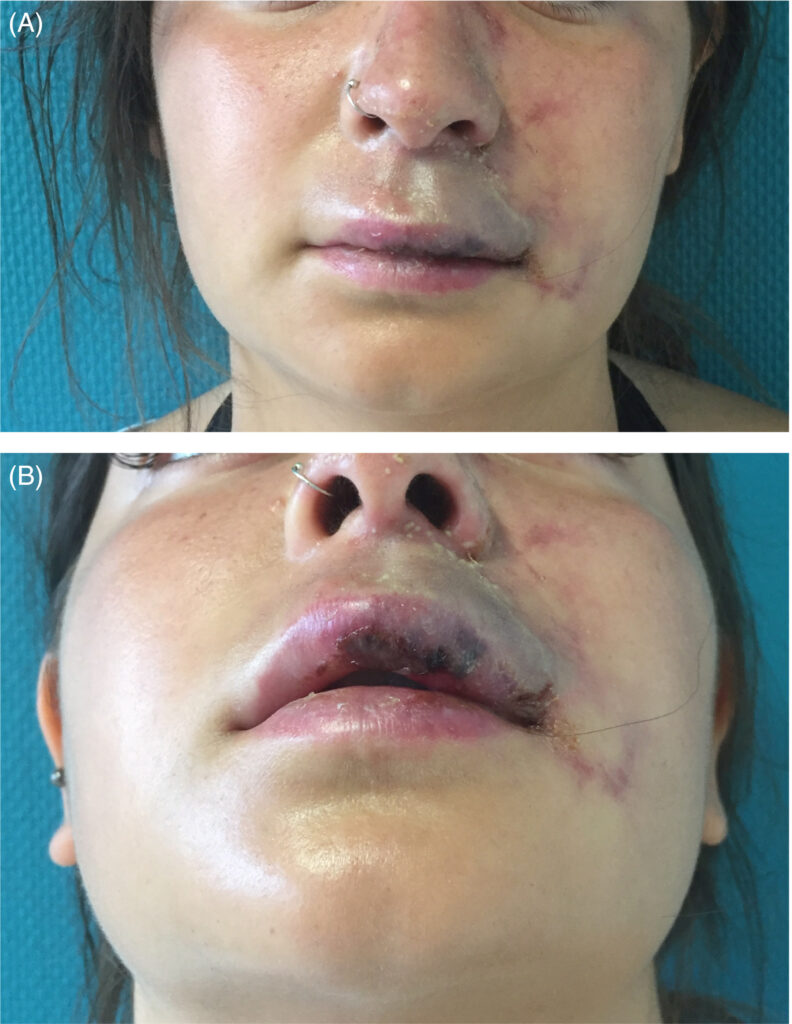 How do I Know if I Have a Vascular Occlusion After Lip Filler