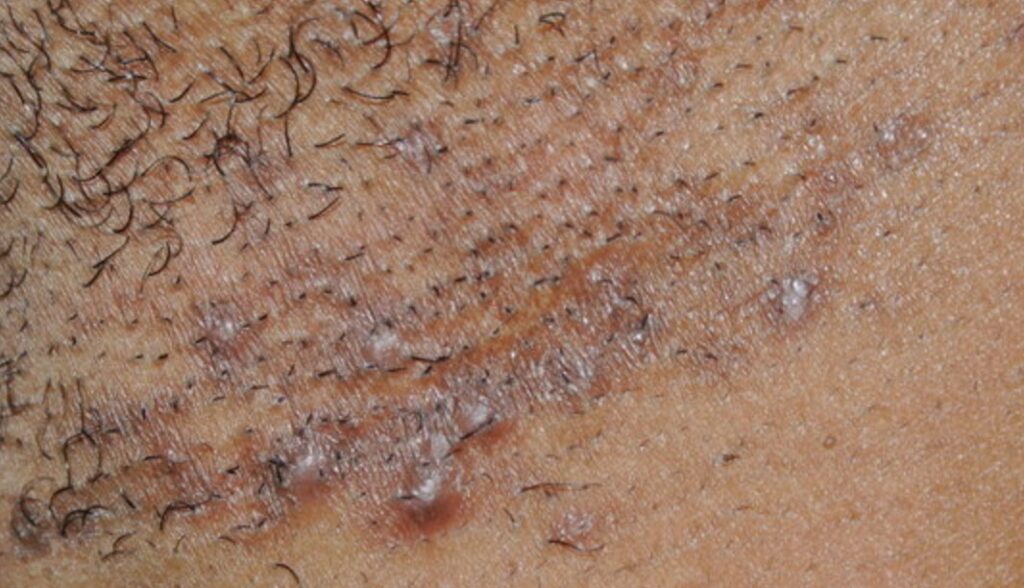 How do You Get Rid of Dark Spots From ingrown Hair Scars