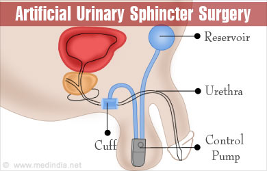 How is Sphincter Surgery Done