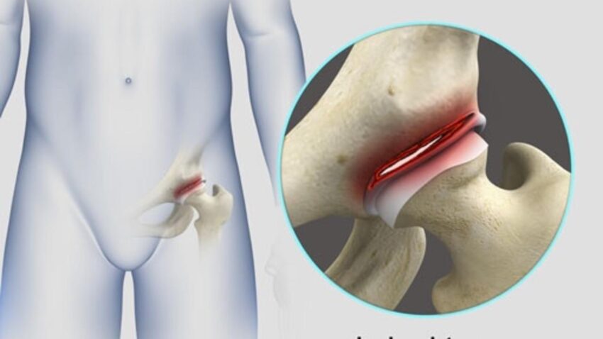 How to Know if Hip Labrum Surgery Failed