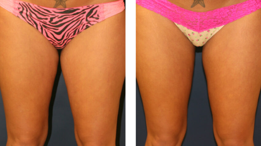 Inner Thigh Liposuction Cost