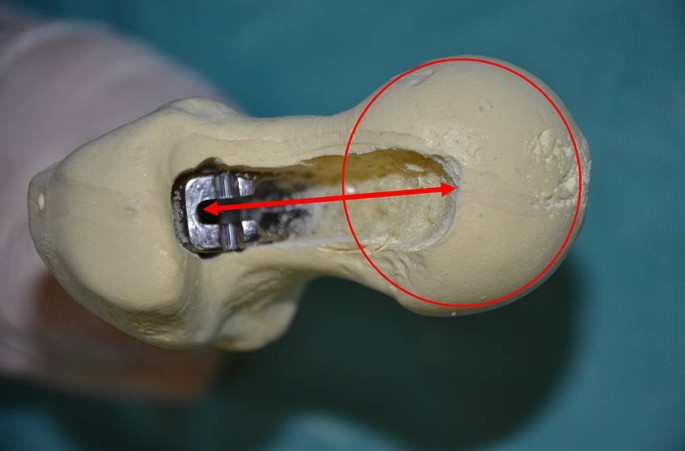 Is SuperPATH the Same as Anterior Hip Replacement