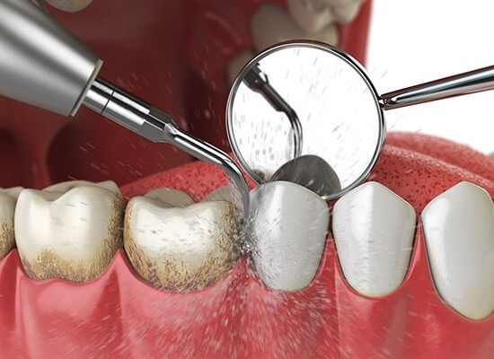 Is a Full Mouth Debridement The Same As a Deep Cleaning