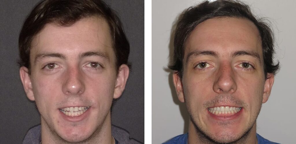 Is it Worth Getting Jaw Surgery for Underbite