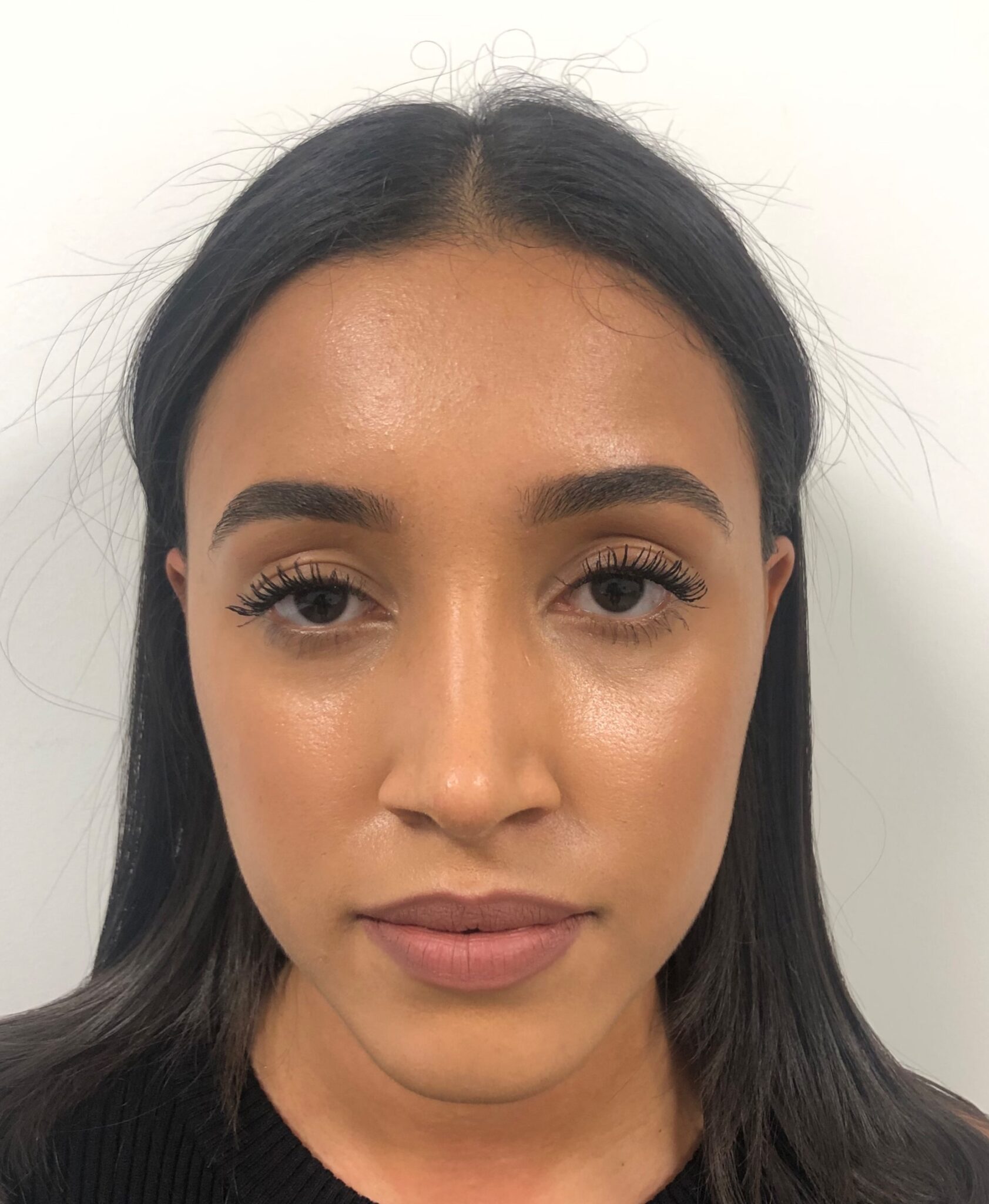 Rhinoplasty Swelling Stages