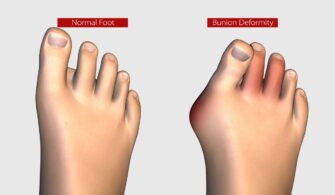 Lapiplasty Bunion Surgery Pros And Cons