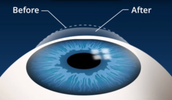 Laser Eye Surgery For Short Sightedness