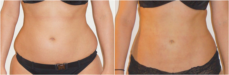 Love Handle Liposuction
