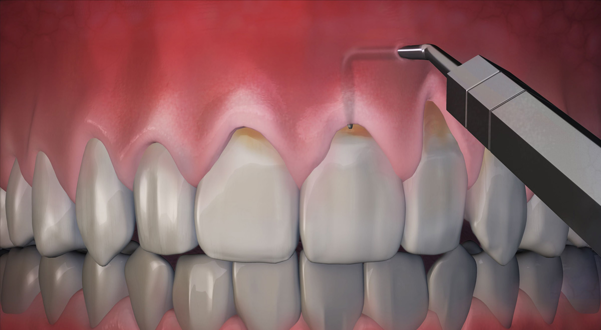 Pinhole Gum Surgery Cost
