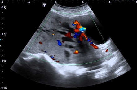 Placenta Accreta Ultrasound