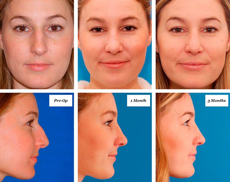 Rhinoplasty Swelling Stages