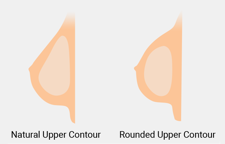 Round vs Teardrop Implants