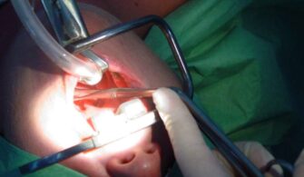 Tonsil Removal Surgery Cost