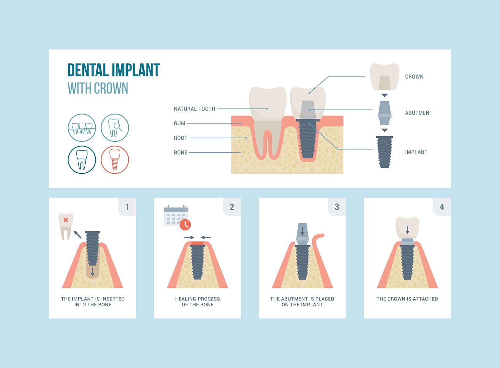 Tooth Extraction And Implant Timeline Tooth Extraction And Implant Timeline