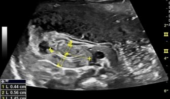 Ultrasound Pyloric Stenosis