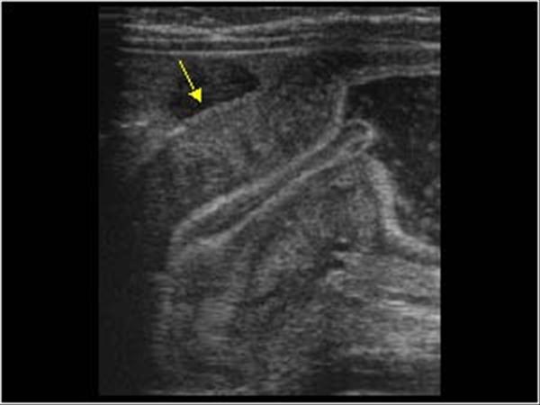 Ultrasound of Pyloric Stenosis