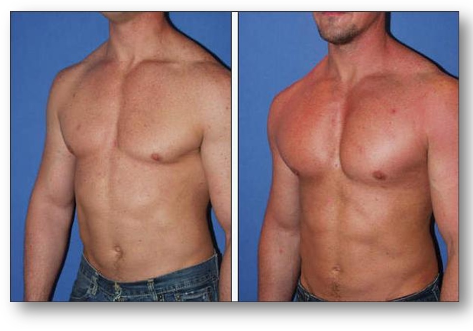 What Are Pec Implants