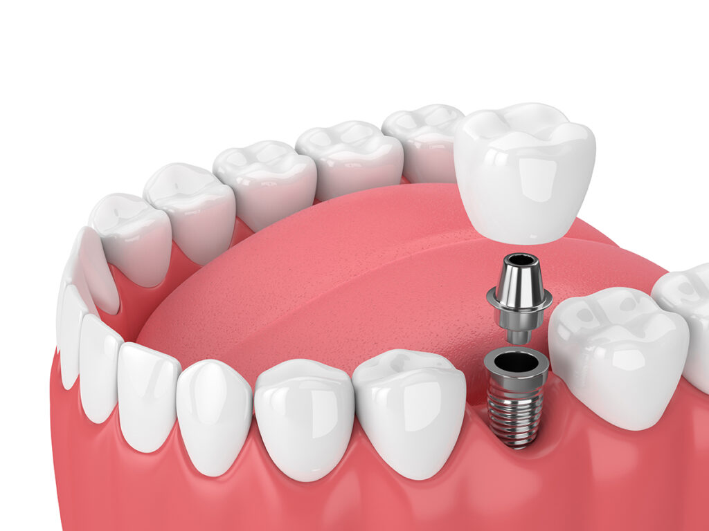What Are The Three Types of Endosteal Implants