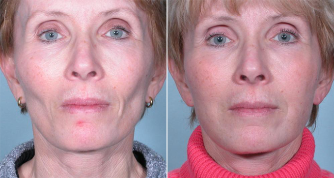 What Are the Risks of Facial Fat Transfer