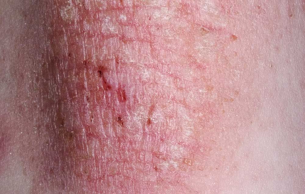 What Eczema Means