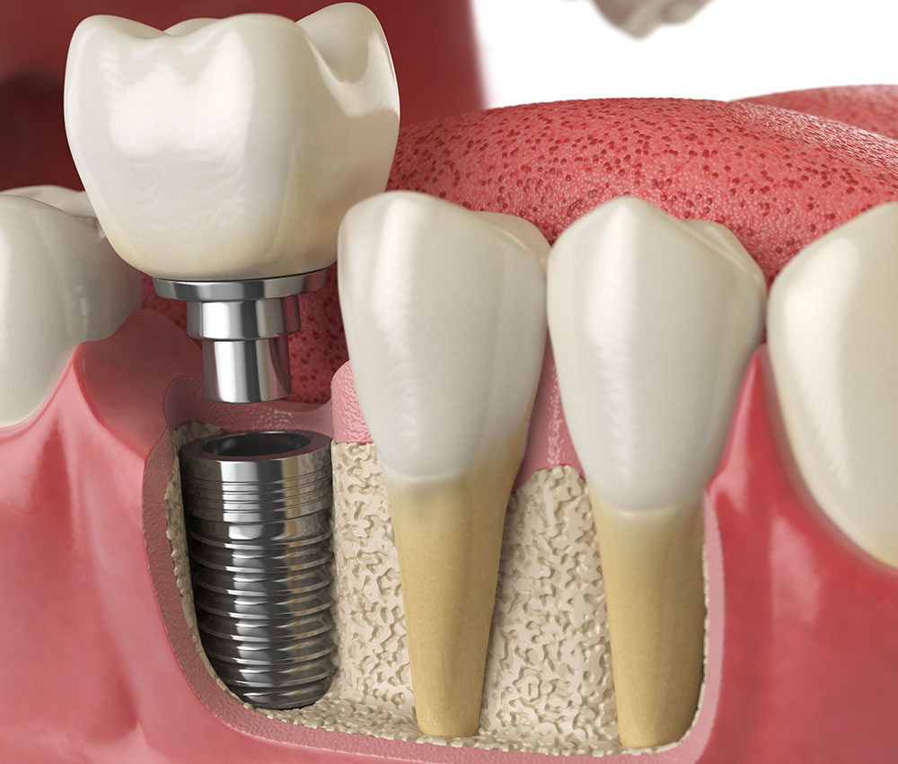 Signs Of Failed Dental Bone Graft