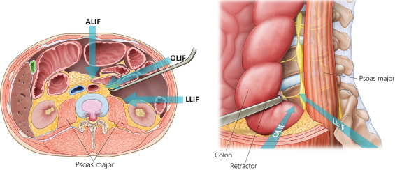 What Is OLIF Surgery