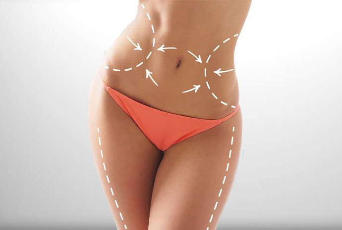 What Is a Flank Liposuction