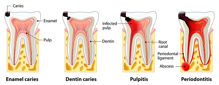 What Should I Do if My Root Canal Tooth Hurts