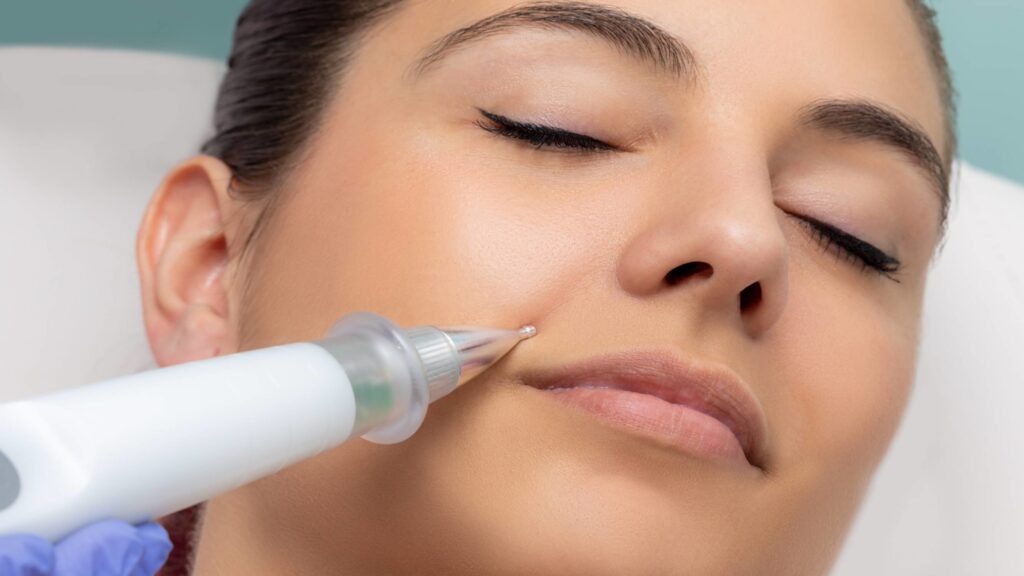 What is Dermavel Plasma Pen