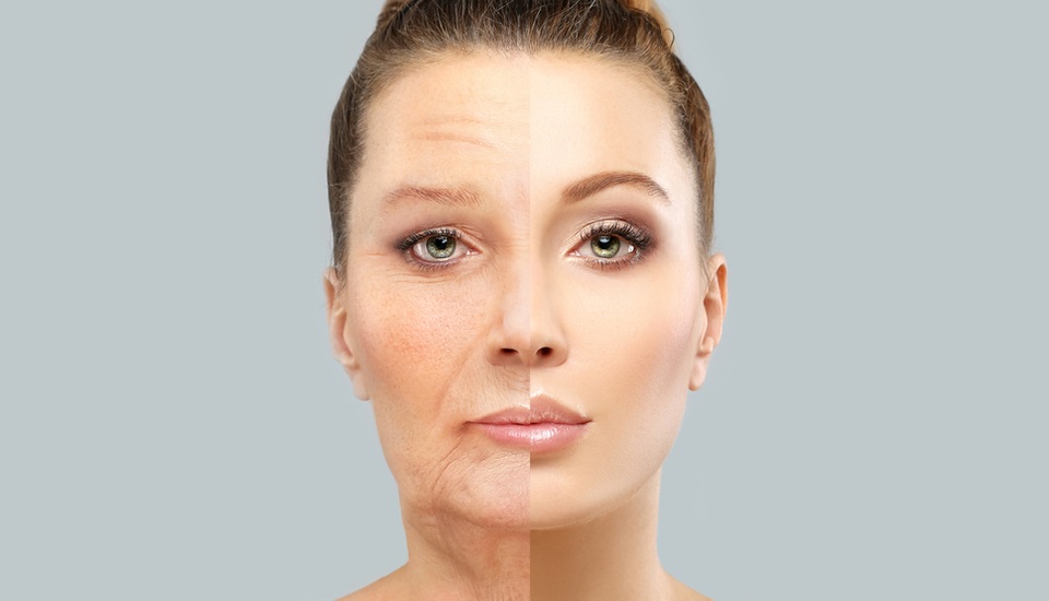 What is The Best Filler For Nasolabial Folds