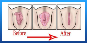 What is Virgin Tightening Surgery