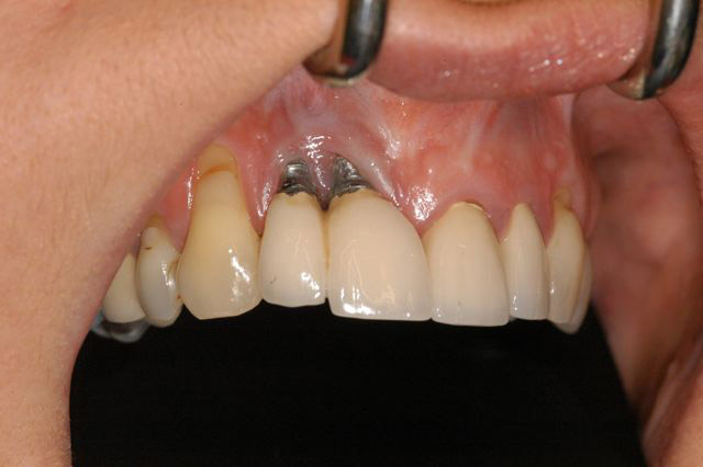 signs-of-failed-dental-bone-graft