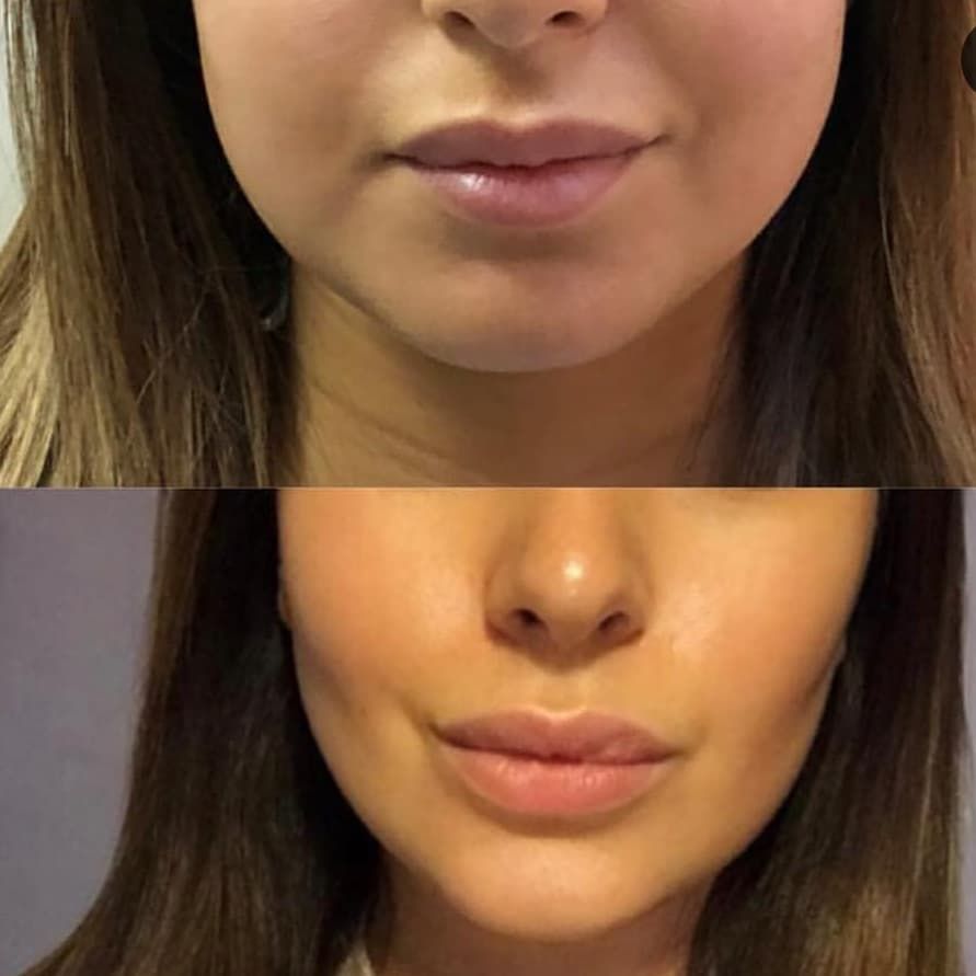 Can Facial Fat Be Removed