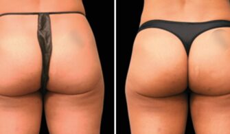 Emsculpt Buttocks Before And After