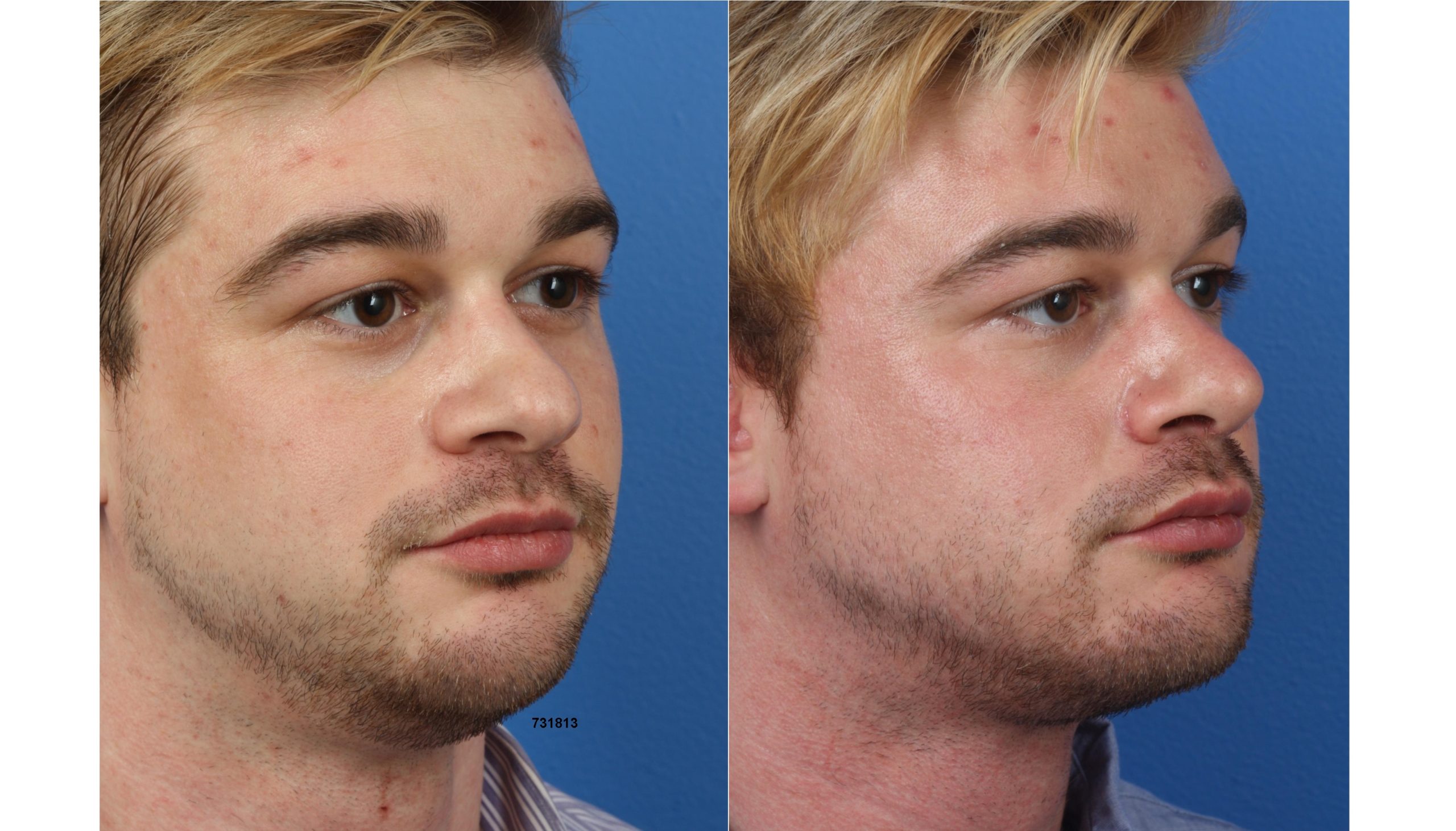 Face Fat Removal