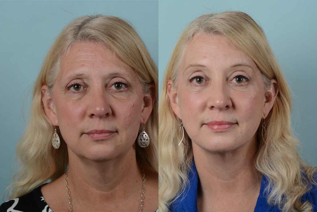 Face Lift Surgery